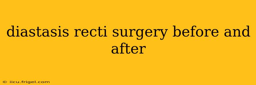 diastasis recti surgery before and after